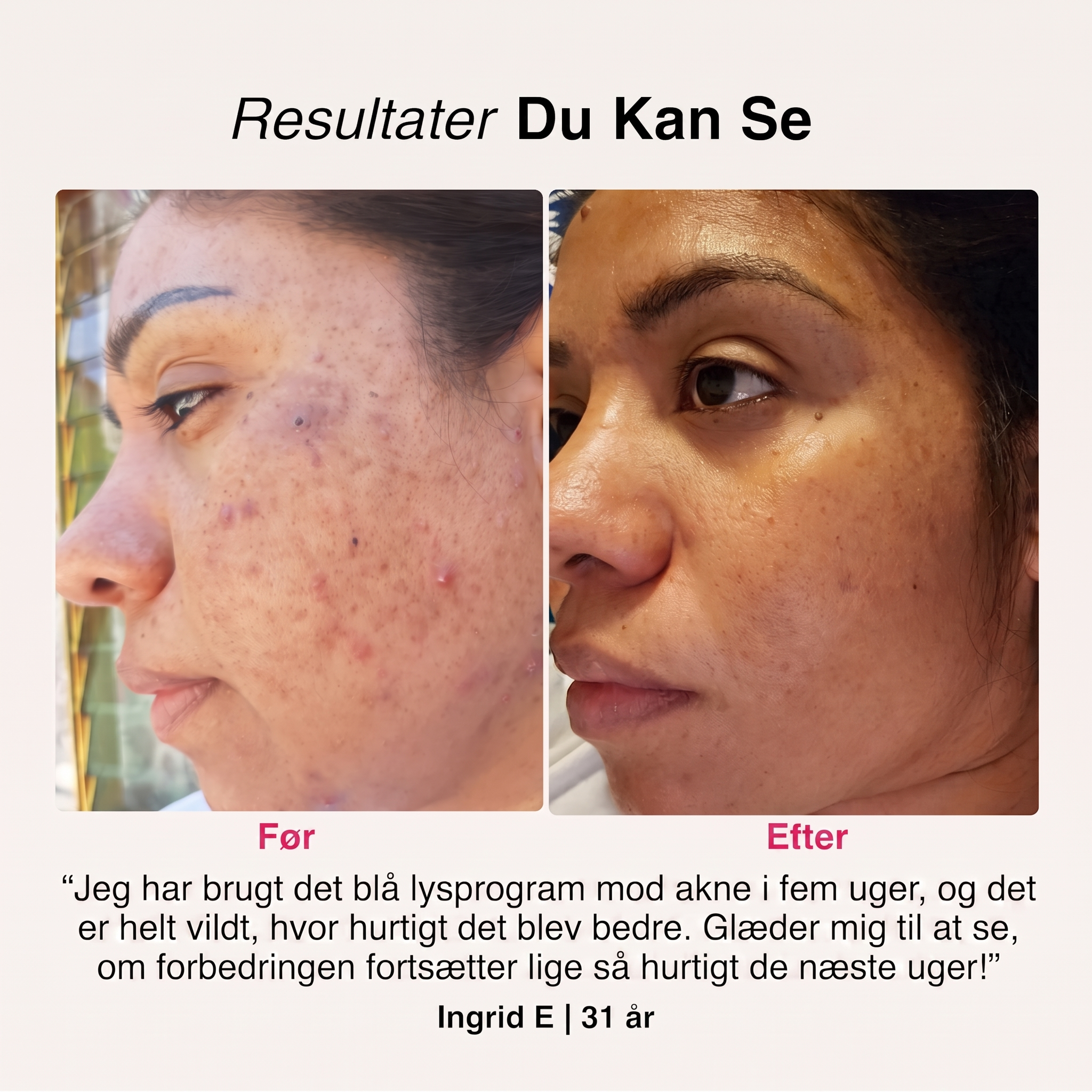 SoftSkin InfraLight | Ansigt, Hals & Bryst