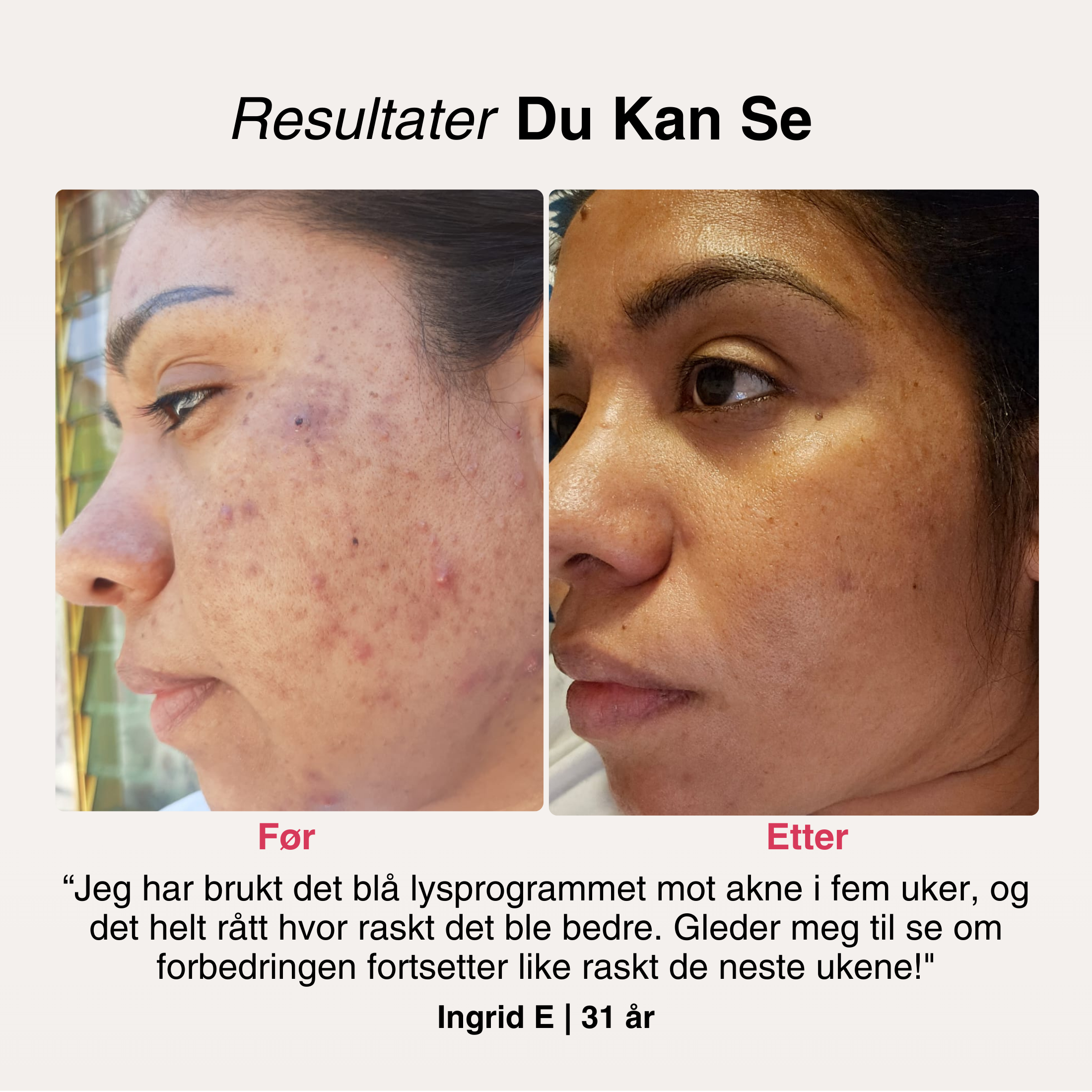 SoftSkin InfraLight® LED-maske