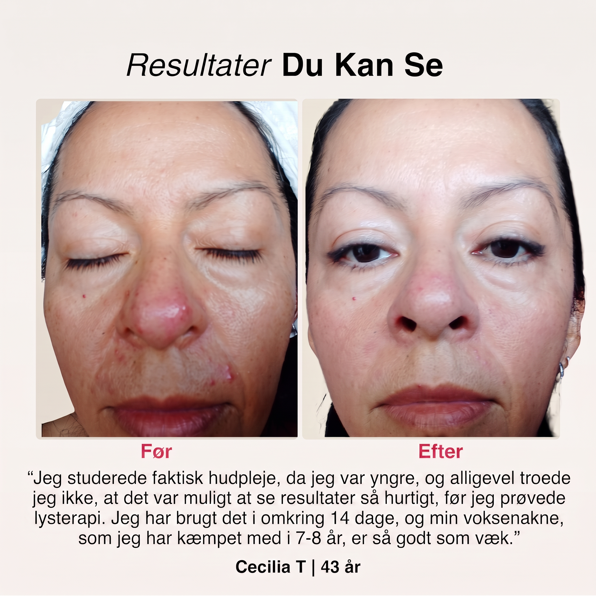SoftSkin InfraLight | Ansigt, Hals & Bryst